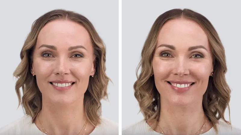 Daxxify before and after