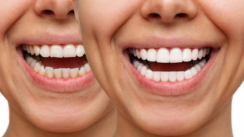 Before and after cosmetic dentistry